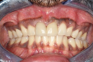 1 After - Dental Group Of Chicago