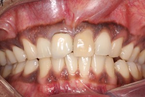 1 Before - Dental Group Of Chicago