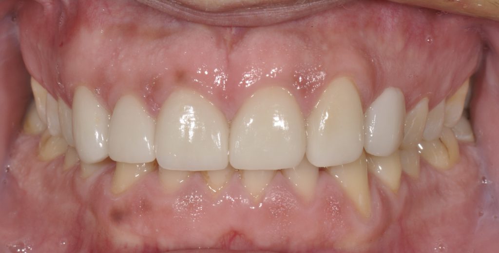 2 After - Dental Group Of Chicago