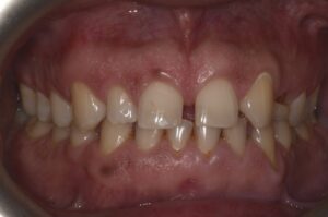 Veneers treatment, before photo