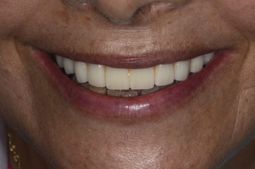 After photo of a patient smile from our practice