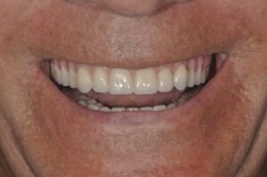 Smile makeover treatment, after photo
