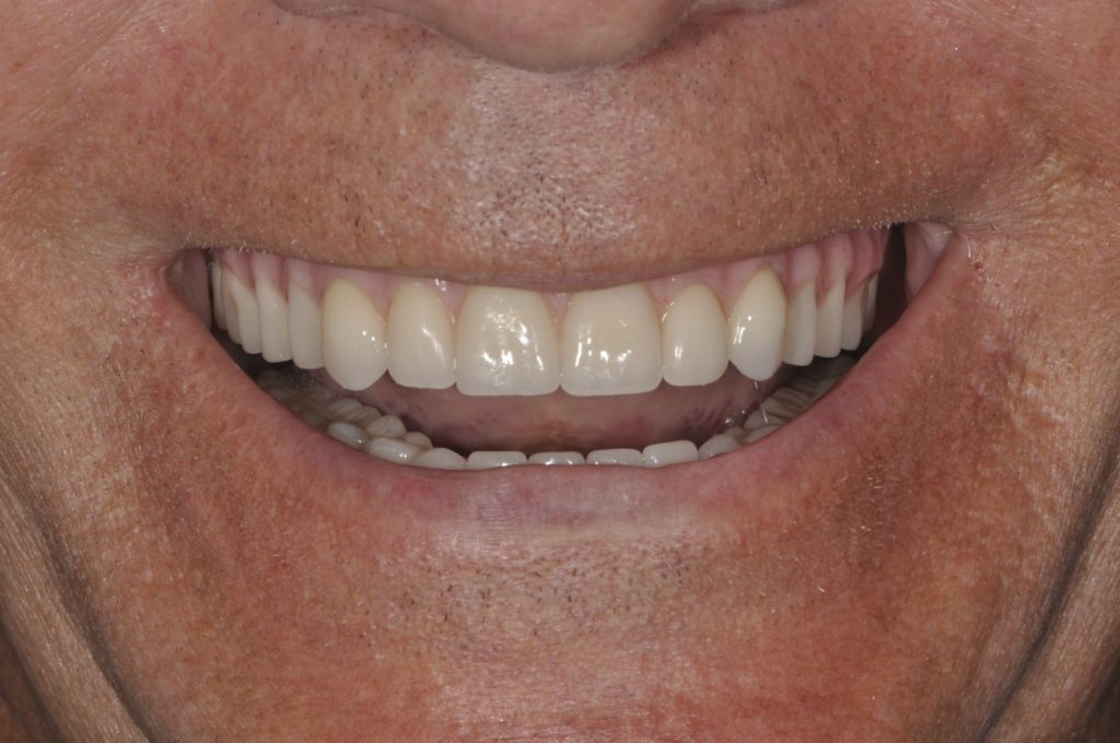 After photo of a patient smile from our practice