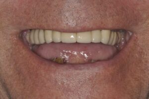 Smile makeover treatment, before photo
