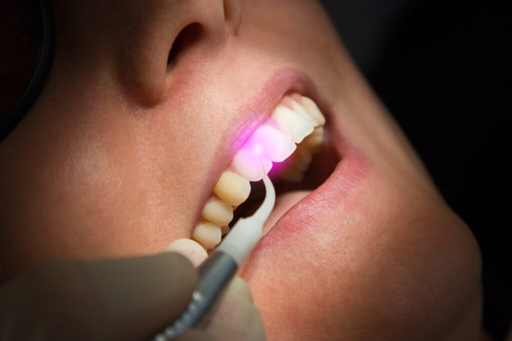 Dental Laser Zahnbehandlung Zahnfleisch