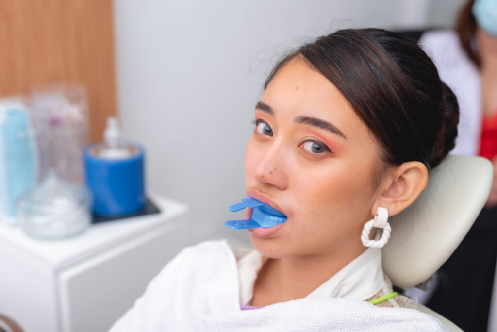 A female patient biting down on a blue fluoride gel foam tray in her mouth. Used for applying fluoride gel to strengthen teeth and prevent cavities during a dental treatment.