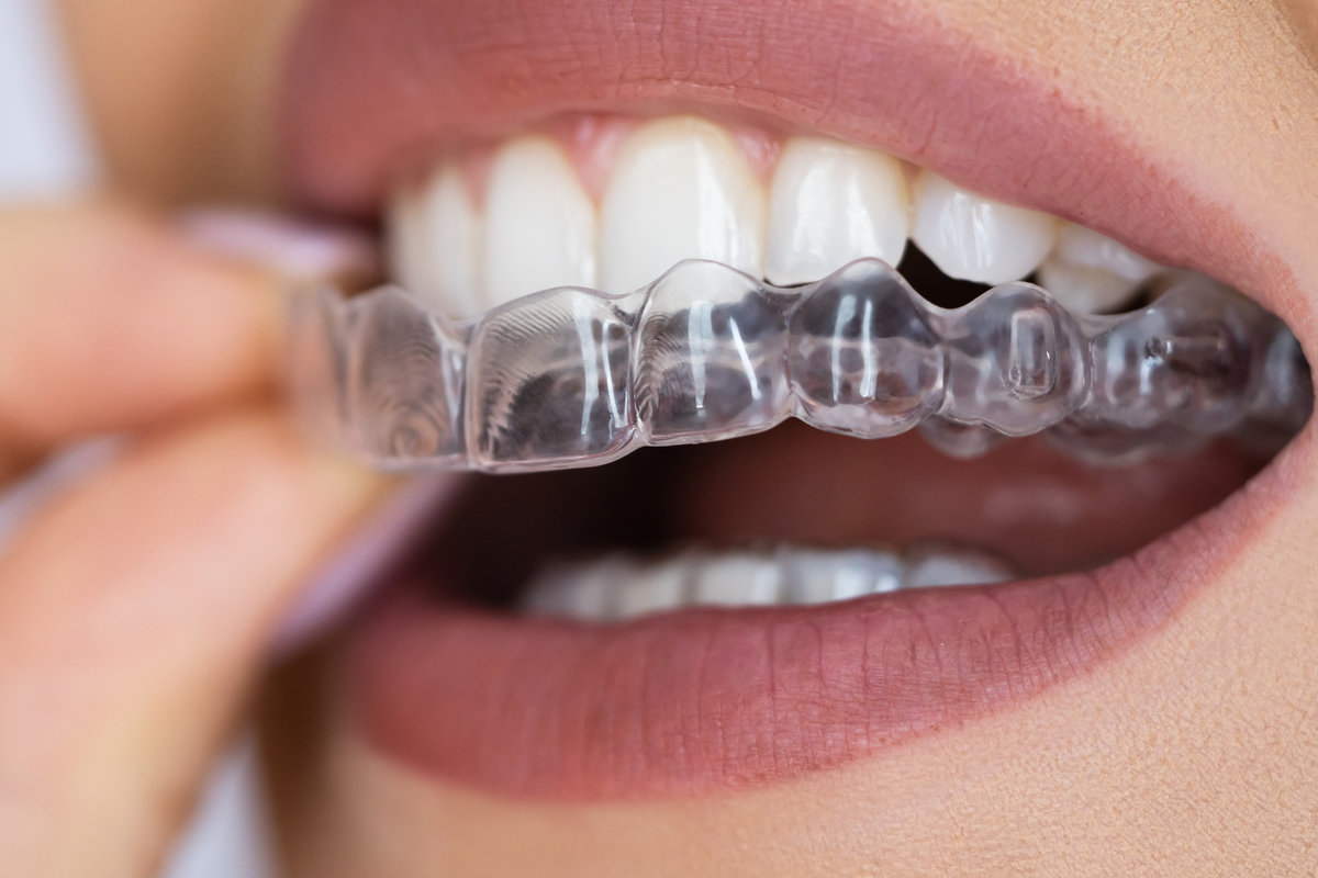 Clear Aligner Dental Night Guard For Teeth